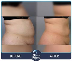 Before and After for Rejuva Medical Spa 