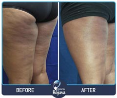 Before and After for Rejuva Medical Spa 