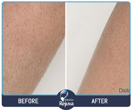 Before and After for Rejuva Medical Spa 