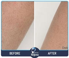 Before and After for Rejuva Medical Spa 