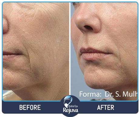 Before and After for Rejuva Medical Spa 