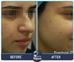 Before and After for Rejuva Medical Spa 