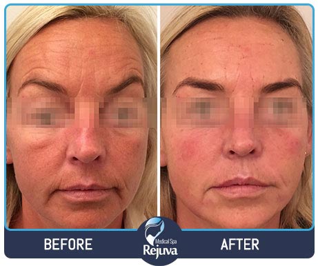 Before and After for Rejuva Medical Spa 