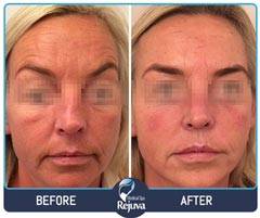 Before and After for Rejuva Medical Spa 