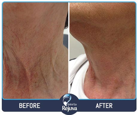 Before and After for Rejuva Medical Spa 