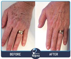 Before and After for Rejuva Medical Spa 