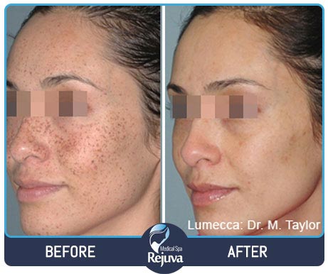 Before and After for Rejuva Medical Spa 