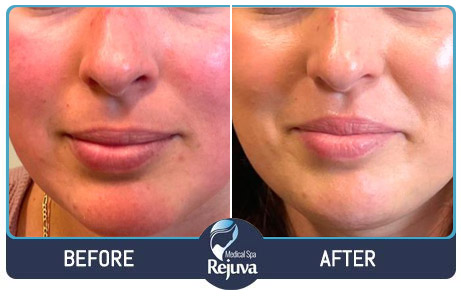 Before and After Images of Clients at Rejuva Medical Spa in Chesapeake, VA Before and After Images of Clients at Rejuva Medical Spa in Chesapeake, VA