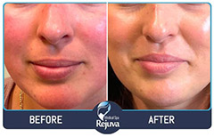 Before and After Images of Clients at Rejuva Medical Spa in Chesapeake, VA Before and After Images of Clients at Rejuva Medical Spa in Chesapeake, VA