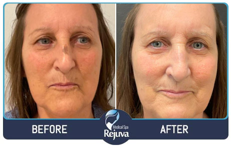 Before and After Images of Clients at Rejuva Medical Spa in Chesapeake, VA Before and After Images of Clients at Rejuva Medical Spa in Chesapeake, VA