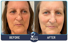 Before and After Images of Clients at Rejuva Medical Spa in Chesapeake, VA Before and After Images of Clients at Rejuva Medical Spa in Chesapeake, VA