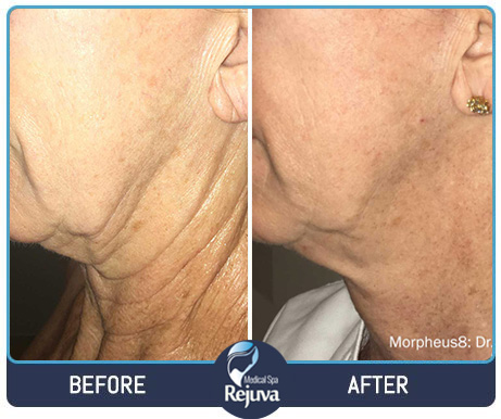 Before and After Images of Clients at Rejuva Medical Spa in Chesapeake, VA Before and After Images of Clients at Rejuva Medical Spa in Chesapeake, VA