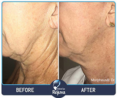 Before and After Images of Clients at Rejuva Medical Spa in Chesapeake, VA Before and After Images of Clients at Rejuva Medical Spa in Chesapeake, VA