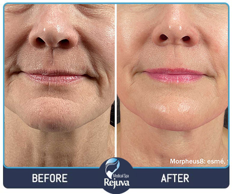 Before and After Images of Clients at Rejuva Medical Spa in Chesapeake, VA Before and After Images of Clients at Rejuva Medical Spa in Chesapeake, VA