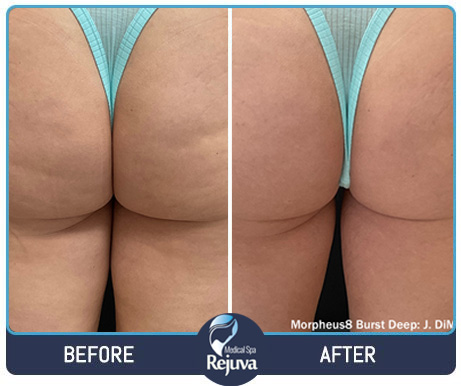 Before and After Images of Clients at Rejuva Medical Spa in Chesapeake, VA Before and After Images of Clients at Rejuva Medical Spa in Chesapeake, VA