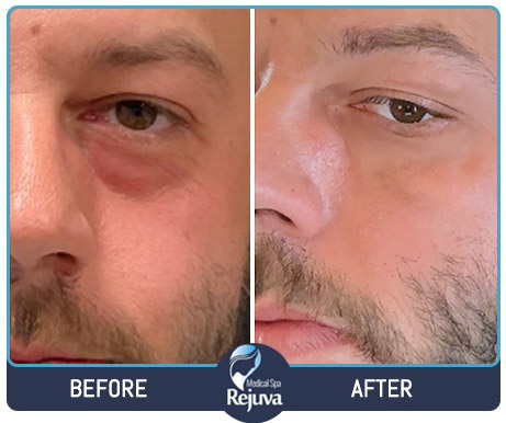 Filler Before and After Images of Clients at Rejuva Medical Spa in Chesapeake, VA