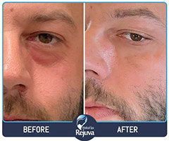 Filler Before and After Images of Clients at Rejuva Medical Spa in Chesapeake, VA