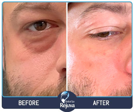 Filler Before and After Images of Clients at Rejuva Medical Spa in Chesapeake, VA