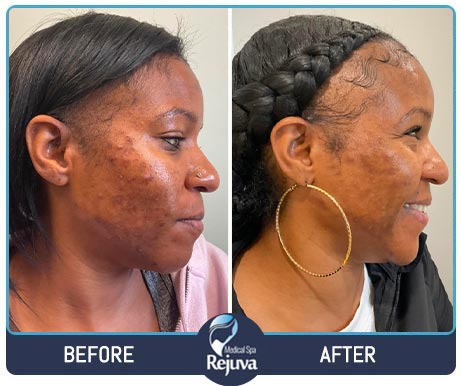 VI Peels Before and After Images of Clients at Rejuva Medical Spa in Chesapeake, VA