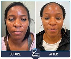 VI Peels Before and After Images of Clients at Rejuva Medical Spa in Chesapeake, VA