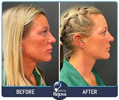 VI Peels Before and After Images of Clients at Rejuva Medical Spa in Chesapeake, VA