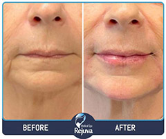 Filler Before and After Images of Clients at Rejuva Medical Spa in Chesapeake, VA